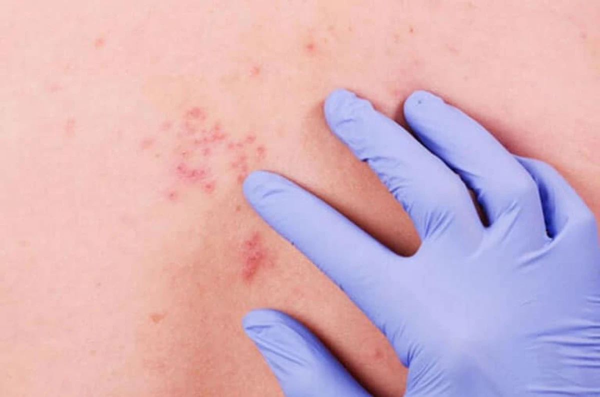 Zona Hastalığına Yönelik Ağrı Tedavileri